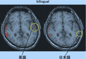 MRI